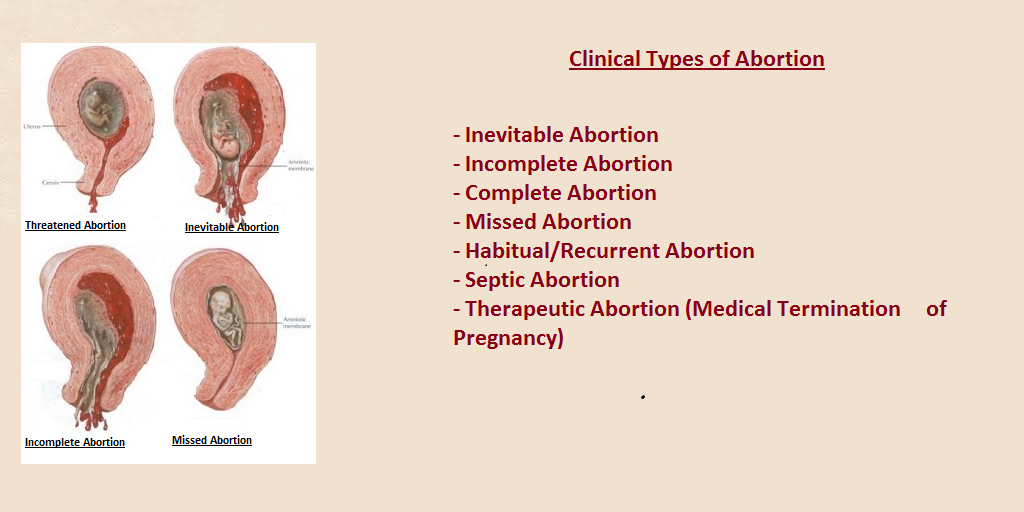 Miscarriage In Pregnancy Why Does It Occur miscarriage-in-pregnancy-why-does-it-occur