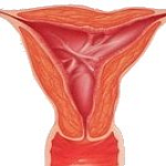 Asherman's Syndrome - Causes, Symptoms and  Treatment.