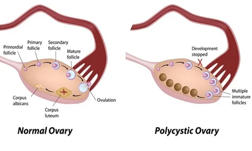 Polycystic Ovarian Syndrome (PCOS)