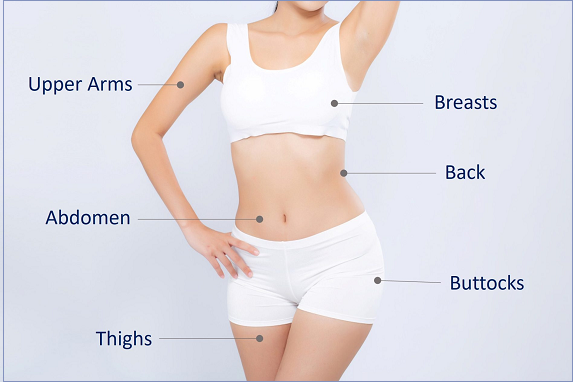  Stretch Marks in pregnancy
