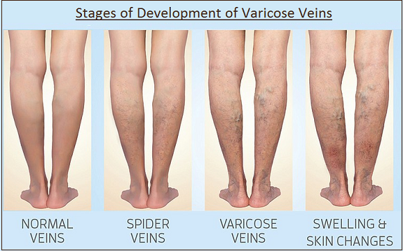  Development of Varicose Veins in pregnancy