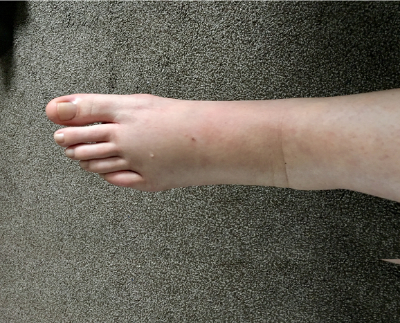  Swollen Ankles in pregnancy