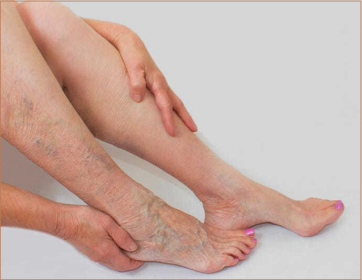  Varicose Veins in pregnancy